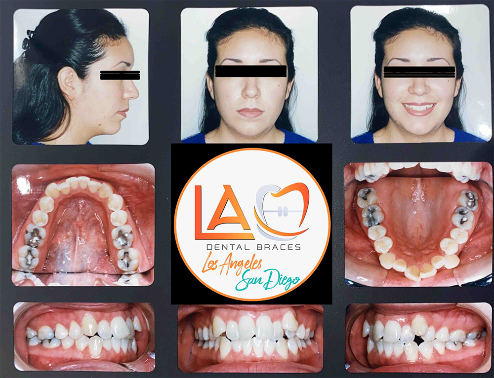 Before and After Photos LA Dental Braces